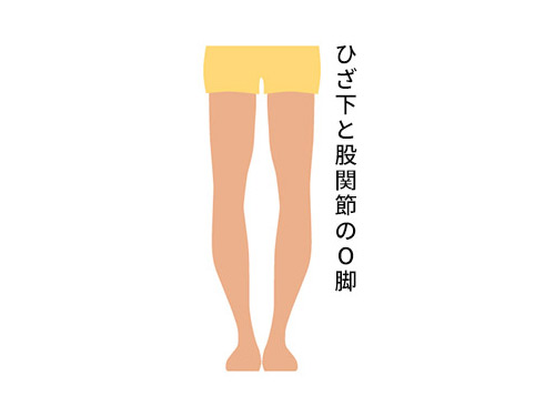 ひざ下と股関節のO脚